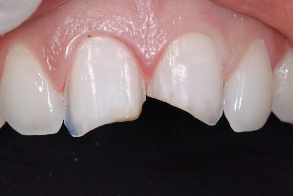 Dan sứ Veneer chỉ thích hợp với những tình trạng răng khiếm khuyết nhẹ