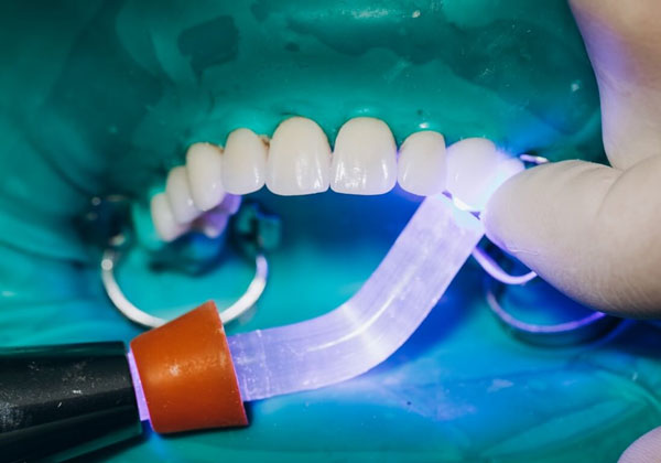 San Dentist là địa chỉ phủ sứ thẩm mỹ chuyên sâu, ứng dụng công nghệ hiện đại