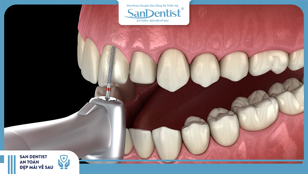 Dán sứ Veneer chỉ cần mài nhám bề mặt răng