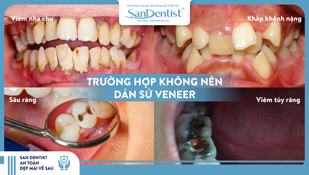 Không phải trường hợp nào cũng có thể điều trị bằng dán sứ Veneer
