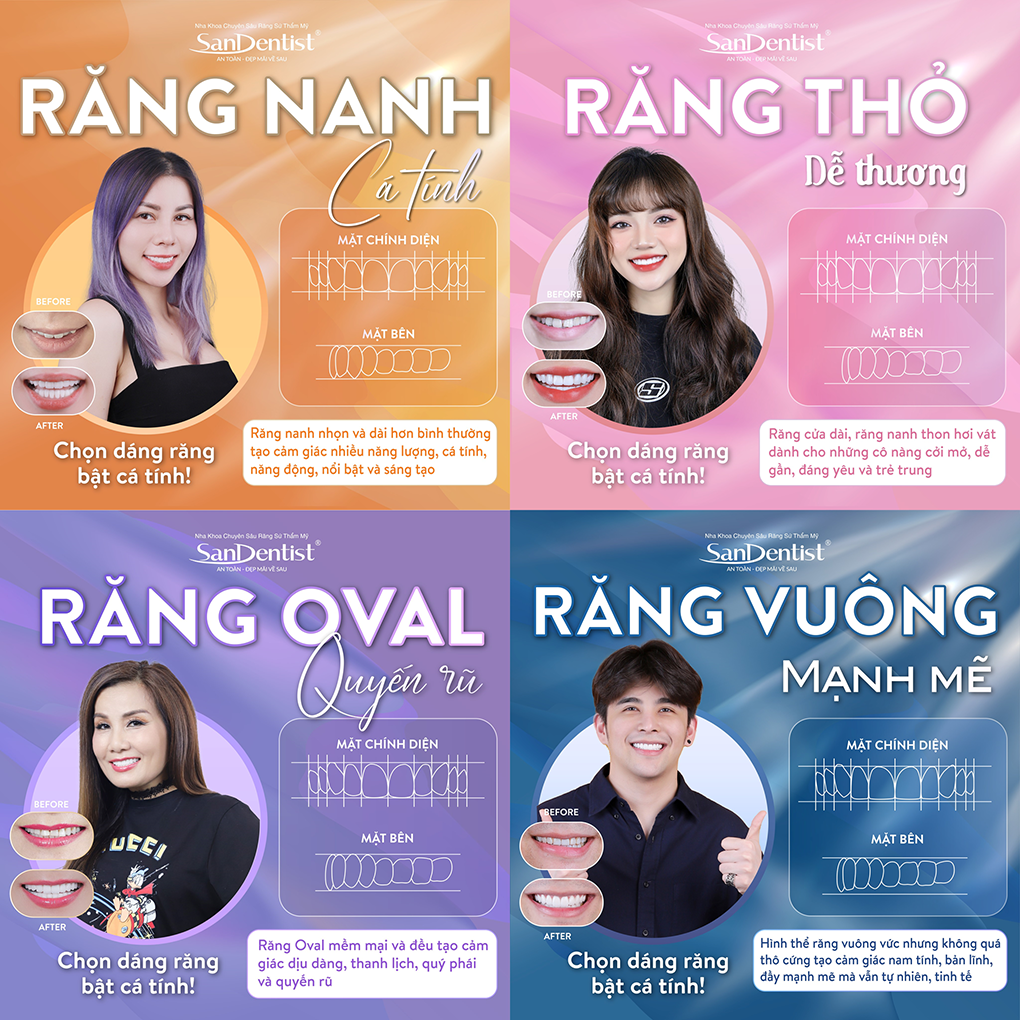 Các dáng răng sứ Veneer được khách hàng San Dentist ưa chuộng