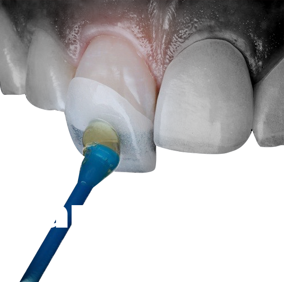 Răng sứ thẩm mỹ