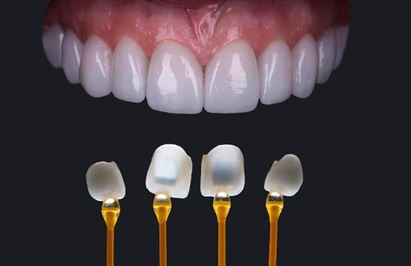 mặt dán sứ Veneer là phương pháp thẩm mỹ giúp bạn che giấu khuyết điểm răng nhanh nhất
