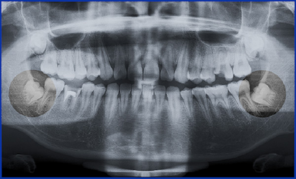 Nhổ răng khôn số 8 bằng máy Piezotome có gì đặc biệt?