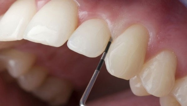 Kỹ thuật phủ sứ thẩm mỹ hạn chế việc mài răng, khắc hẳn so với bọc sứ