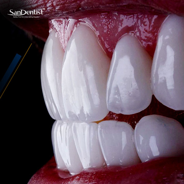 Công nghệ phủ răng sứ hiện đại khắc phục được những khuyết điểm của phương pháp bọc răng sứ truyền thống