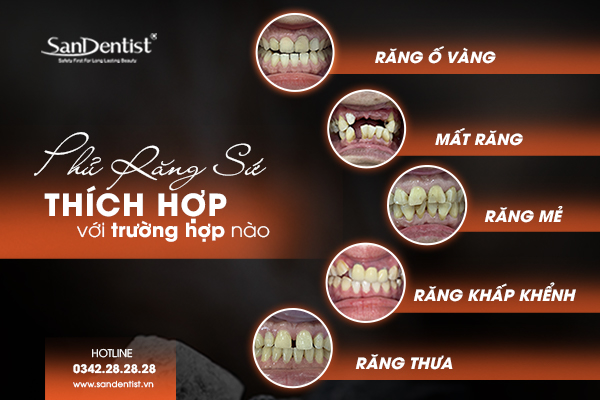 Phủ răng sứ thẩm mỹ thích hợp để phục hình các trường hợp răng khiếm khuyết
