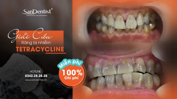 Ưu đãi miễn phí 100% chi phí điều trị răng bị nhiễm Tetracycline