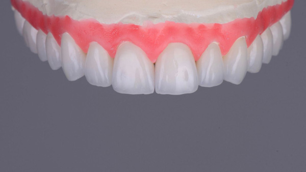 Răng sứ Zolid Plus thuộc nhóm các loại răng sứ phục hình thẩm mỹ