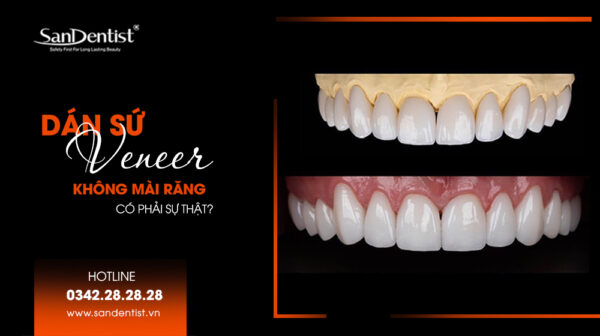 Dán sứ Veneer không mài răng và những điều bạn cần biết!