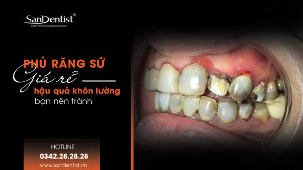 Phủ răng sứ giá rẻ hậu quả khôn lường bạn nên tránh