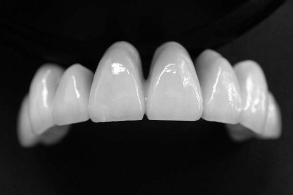Bọc răng sứ là phương pháp phục hình răng sứ ra đời đầu tiên.
