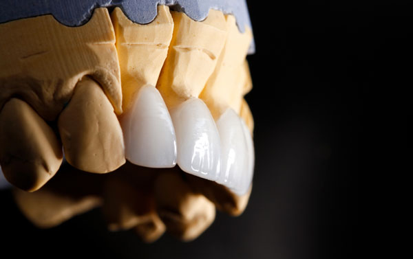 Răng sứ toàn sứ có tuổi thọ và độ bền chắc cao nhất từ 15 - 20 năm