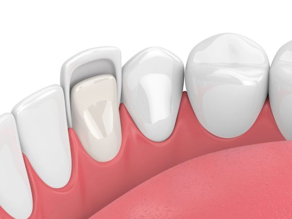 Chất lượng mặt dán sứ, số lượng răng, dịch vụ nha khoa,... là những yếu tố ảnh hưởng đến giá dán sứ Veneer