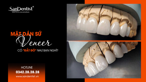 Giải đáp thắc mắc: Mặt dán sứ Veneer giá bao nhiêu?