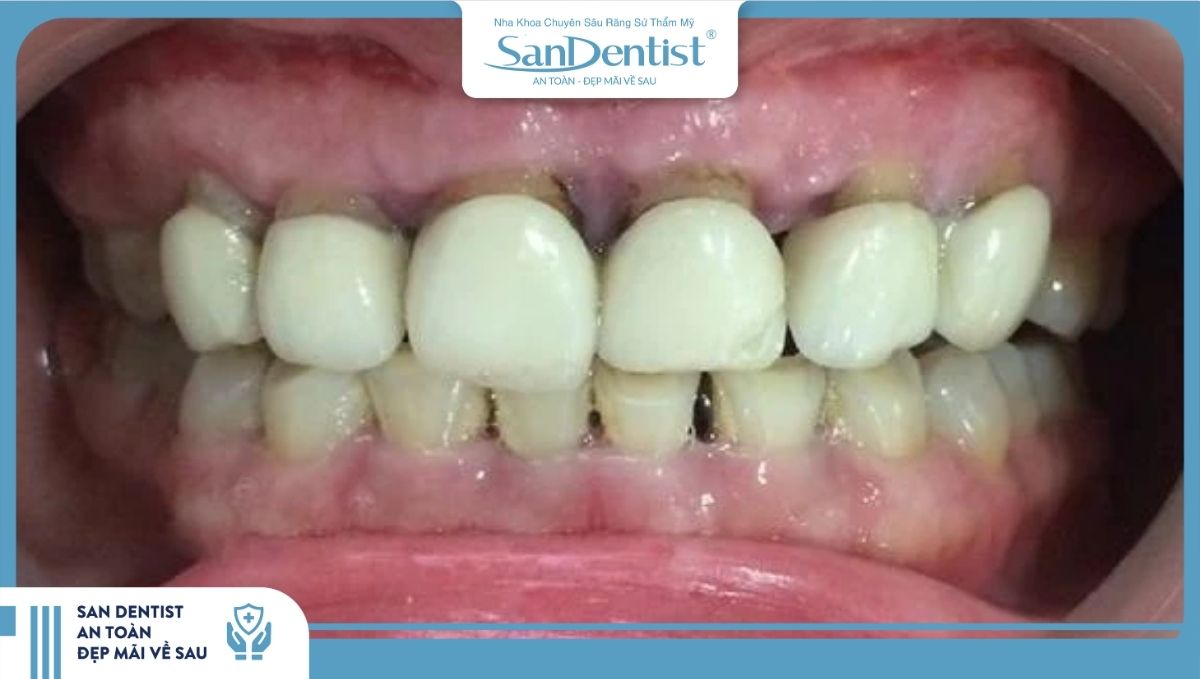 Các loại răng sứ kém chất lượng khi sử dụng một thời gian sẽ gây ra mùi hôi khó chịu