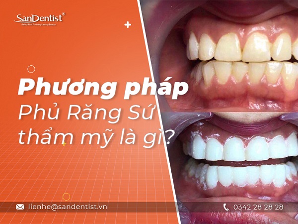 Phương pháp phủ răng sứ và những điều cần biết