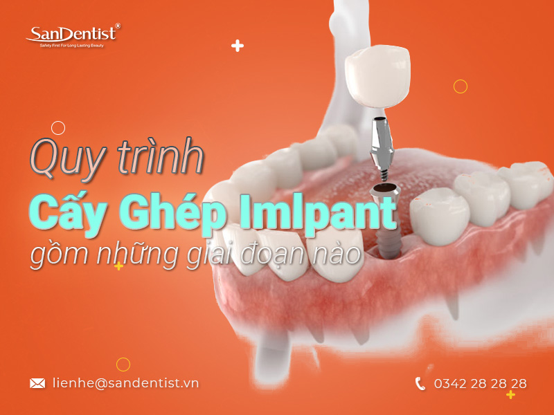 giá làm răng sứ implant