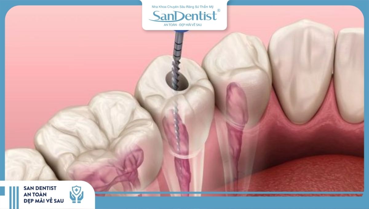 Lấy tủy răng để loại bỏ phần tủy bị viêm nhiễm hoặc hoại tử giúp bảo vệ răng