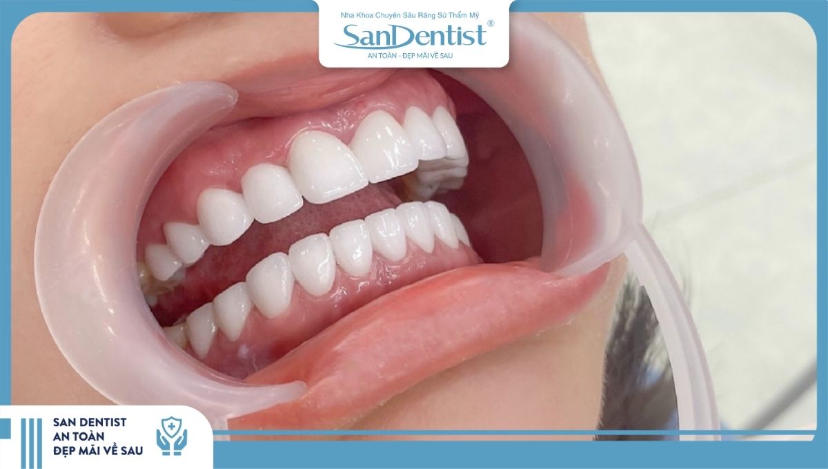 Sau khi bọc răng sứ bạn nên theo dõi tình trạng răng miệng liên tục