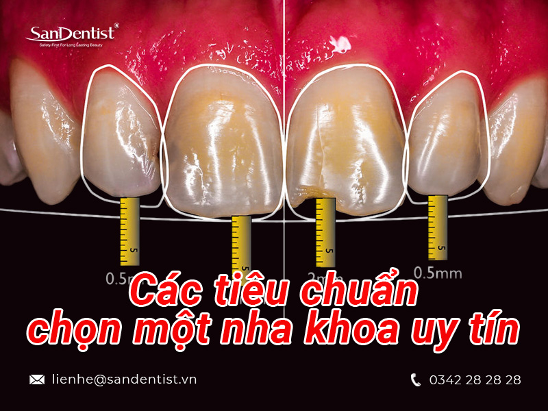 Làm răng sứ thẩm mỹ ở đâu tại Hồ Chí Minh?
