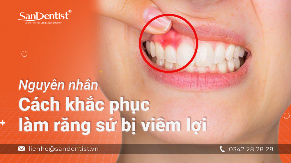Nguyên nhân, cách khắc phục làm răng sứ bị viêm lợi