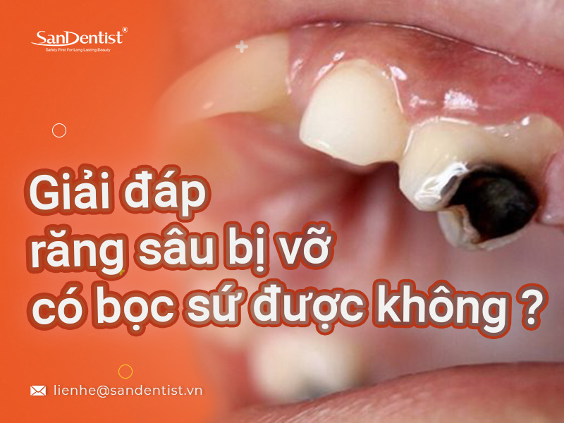 Giải đáp từ chuyên gia: Răng sâu bị vỡ có bọc sứ được không?