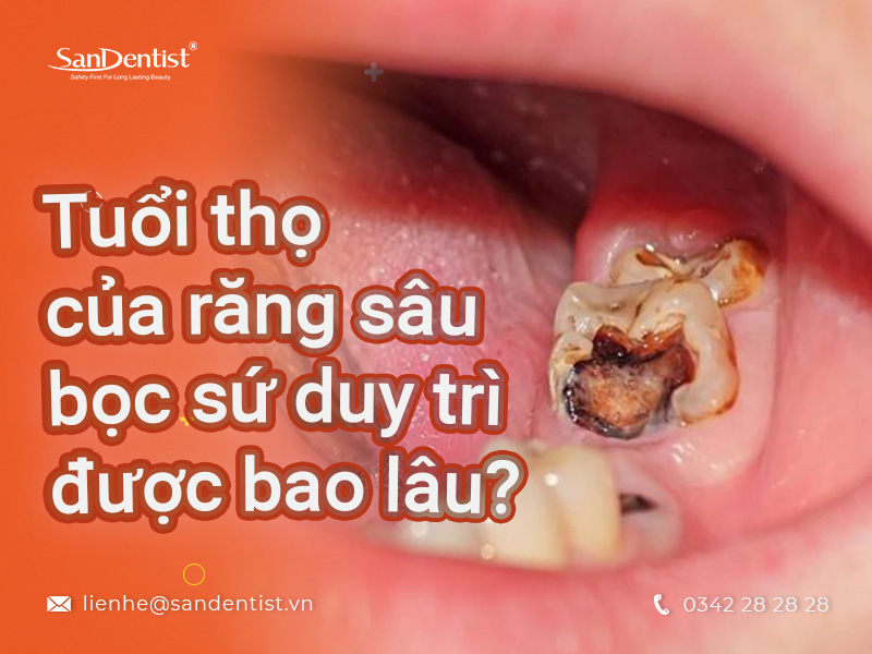 Giải đáp từ chuyên gia: Răng sâu bị vỡ có bọc sứ được không?