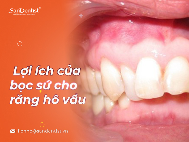 Bọc răng sứ cho răng hô vẩu có được không?