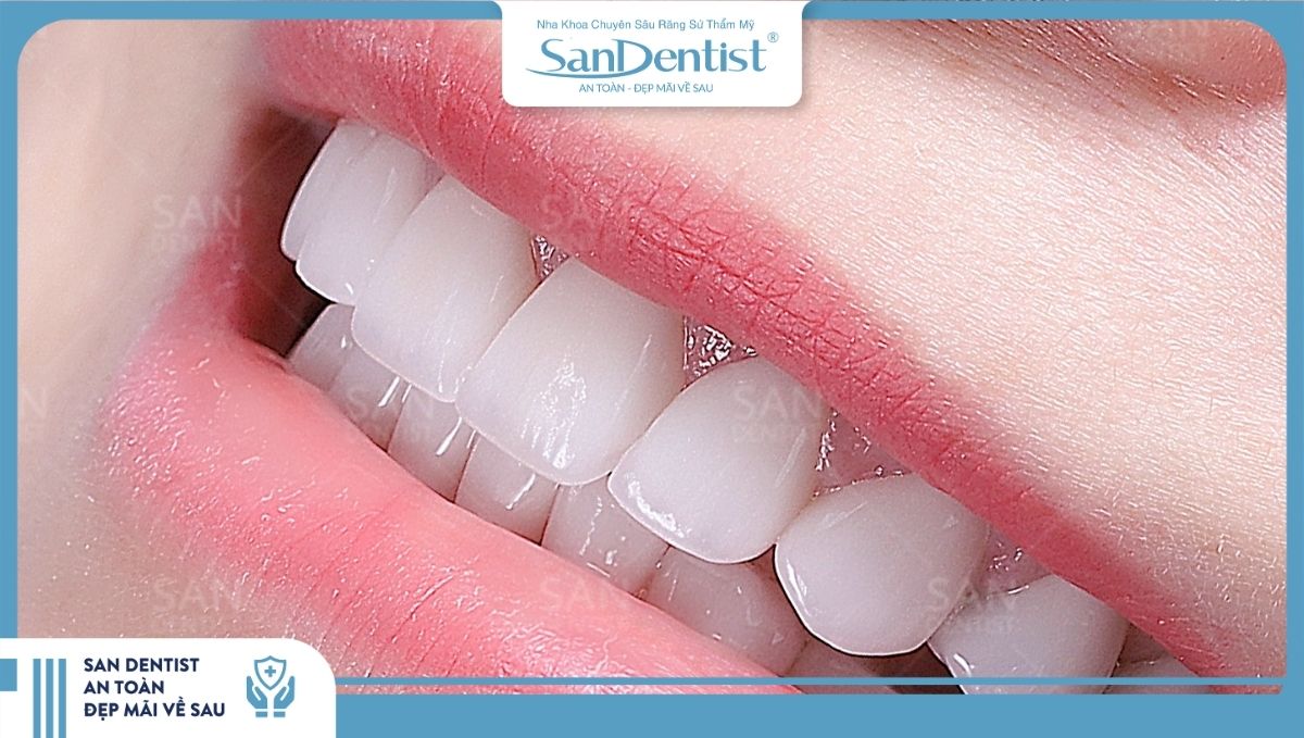 Bọc răng sứ là phương pháp làm đẹp được ưa chuộng tại TPHCM
