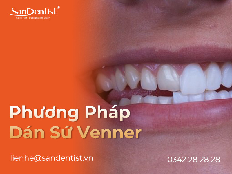 Tổng hợp các phương pháp làm răng thẩm mỹ mới nhất hiện nay