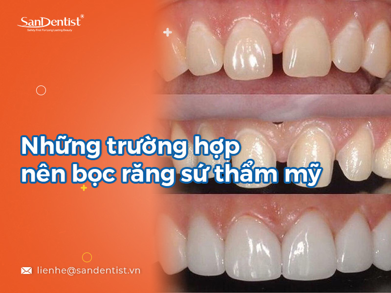 Có nên bọc răng sứ thẩm mỹ? Những trường hợp nên bọc răng sứ