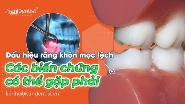 Dấu hiệu răng khôn mọc lệch – Các biến chứng có thể gặp phải