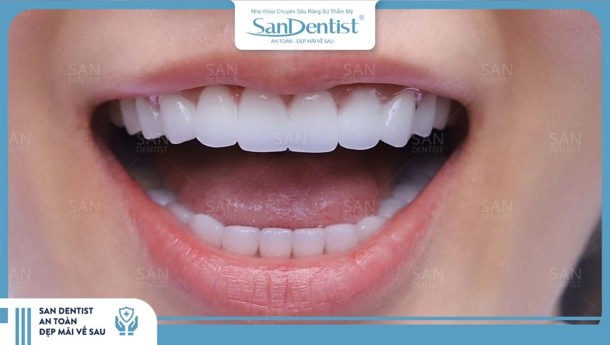 San Dentist cam kết mang đến trải nghiệm bọc răng sứ an toàn và chất lượng