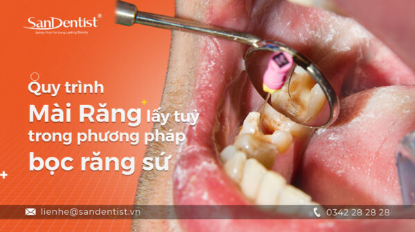 Quy trình mài răng lấy tuỷ trong phương pháp bọc răng sứ