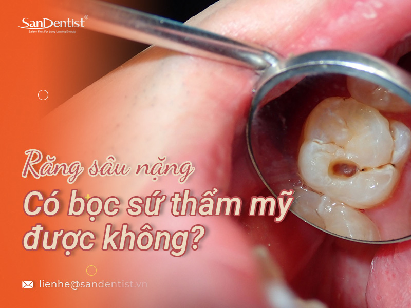 Răng sâu nặng có bọc sứ được không hay nên chọn phương pháp nào?