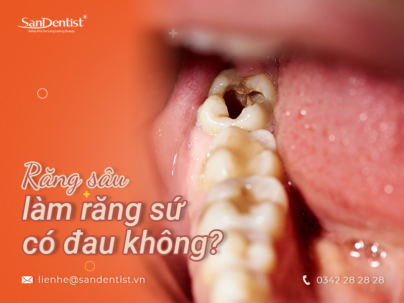 Răng sâu nặng có bọc sứ được không hay nên chọn phương pháp nào?