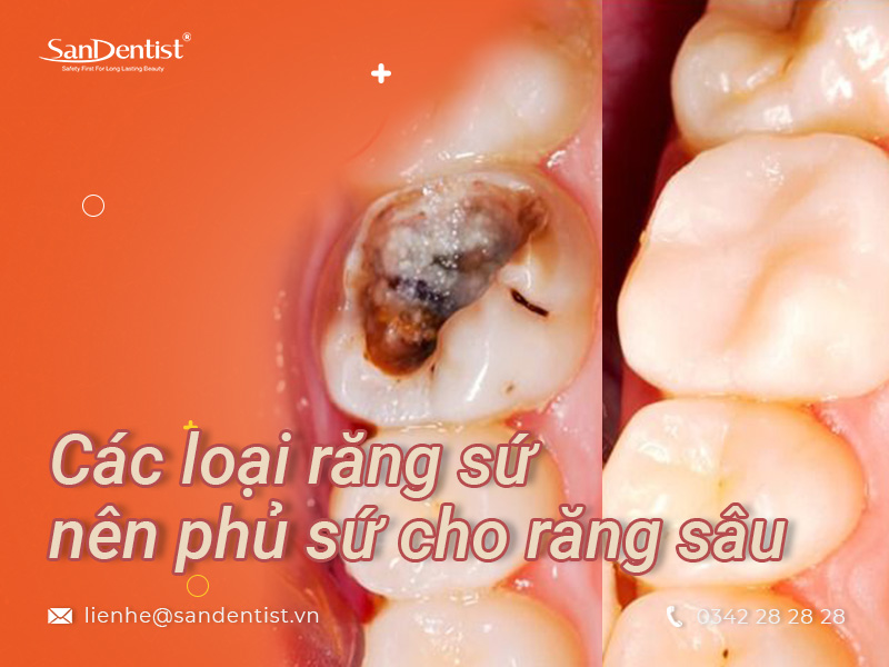 Răng sâu nặng có bọc sứ được không hay nên chọn phương pháp nào?