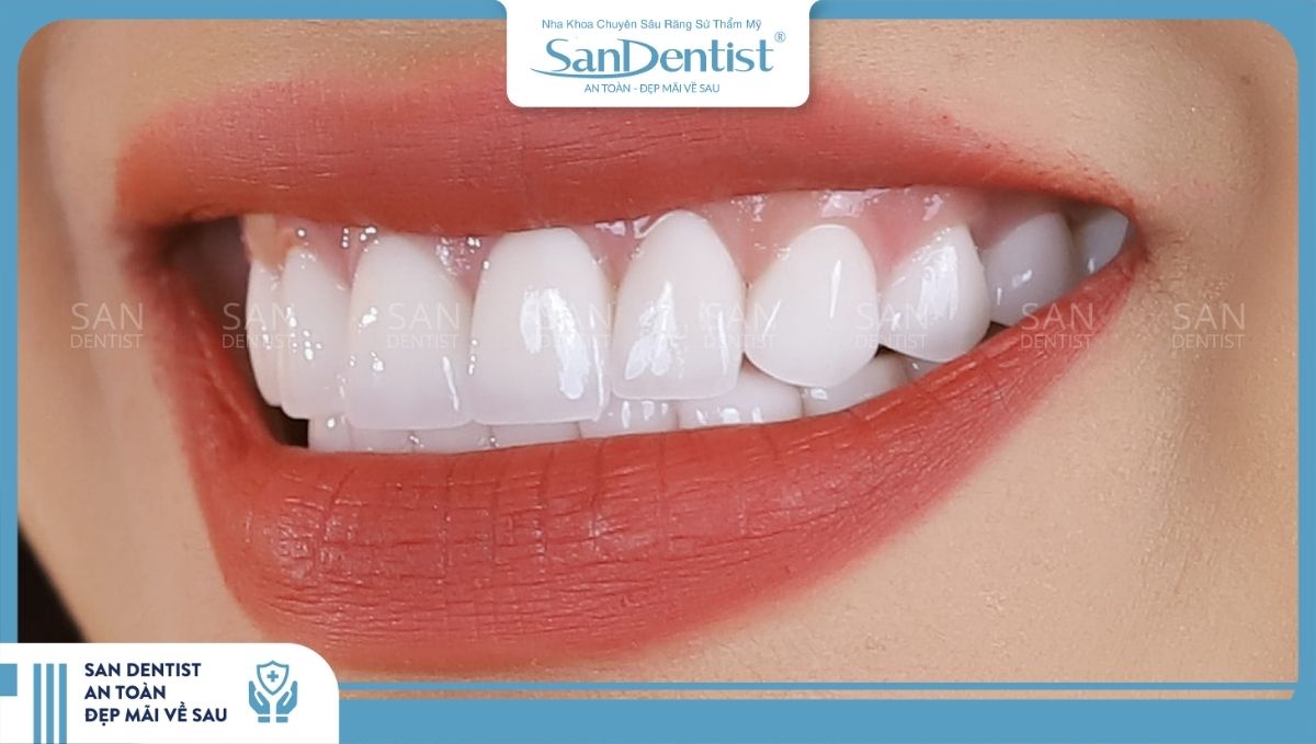 Các tiêu chuẩn đối với một hàm răng sứ đẹp