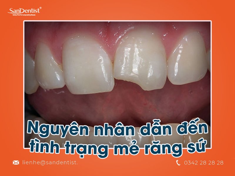 Mẻ răng sứ phải làm sao để khắc phục?