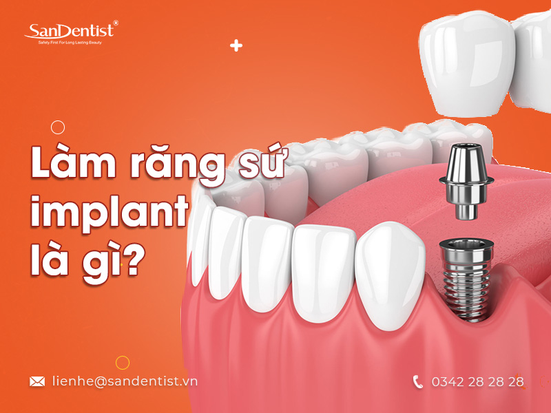 Bật mí ưu điểm khi làm răng sứ implant