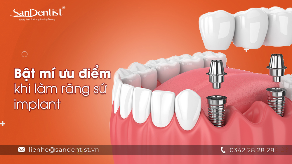 Bật mí ưu điểm khi làm răng sứ implant