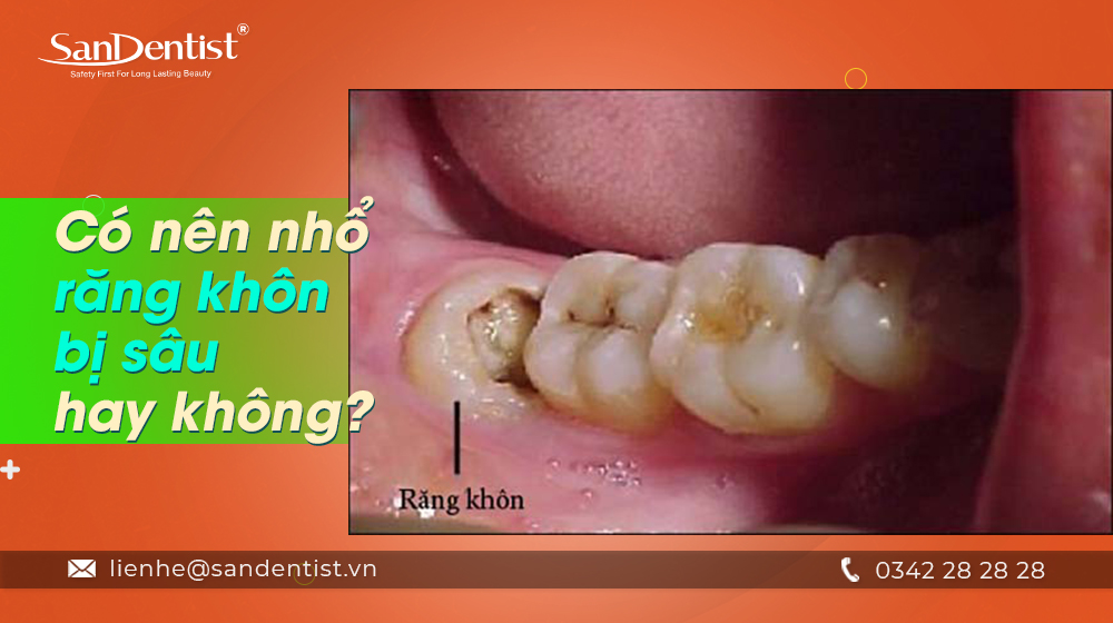 4. Những trường hợp nên nhổ răng khôn sâu