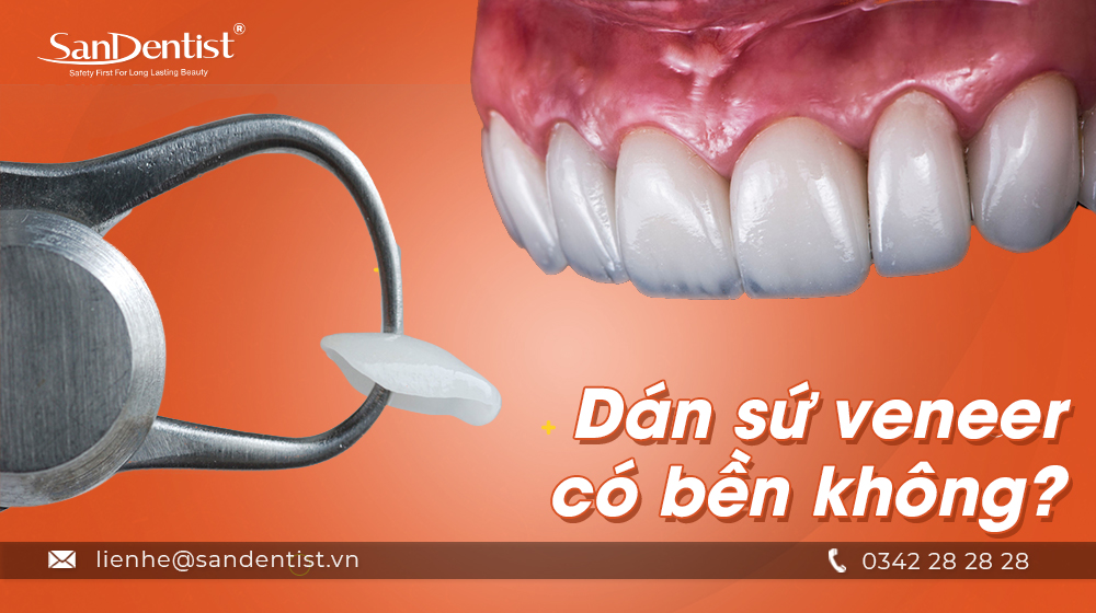 Dán sứ veneer có bền không? [TÌM HIỂU NGAY]