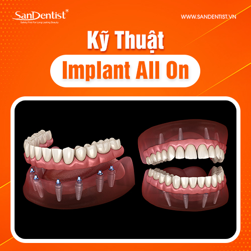Kỹ Thuật Implant All On
