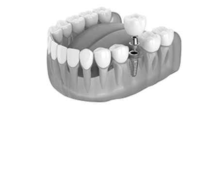 Cấy Ghép Implant