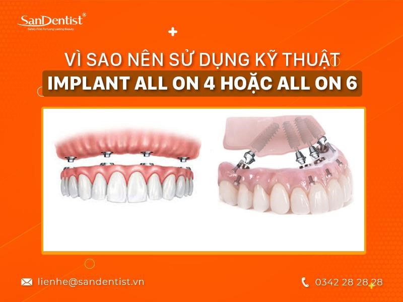 Kỹ Thuật Implant All On