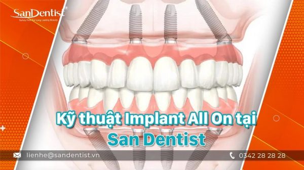 Kỹ Thuật Implant All On