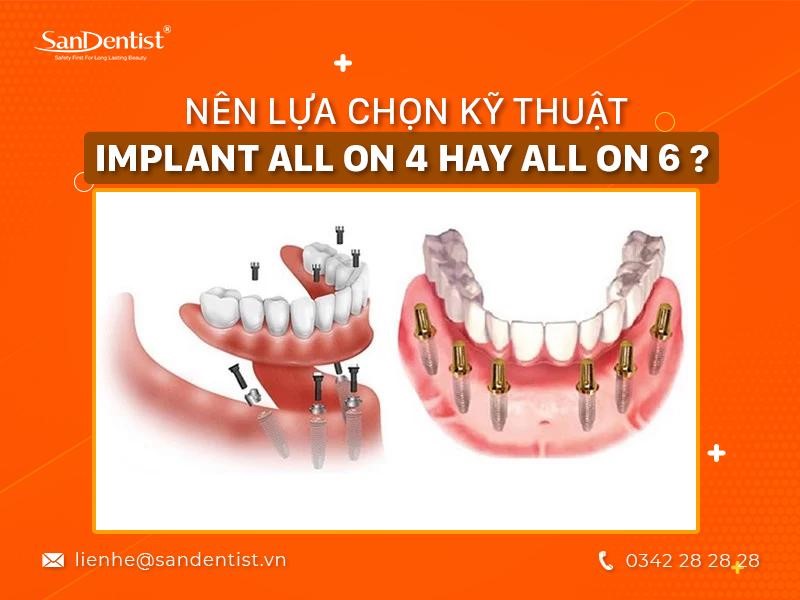 Kỹ Thuật Implant All On
