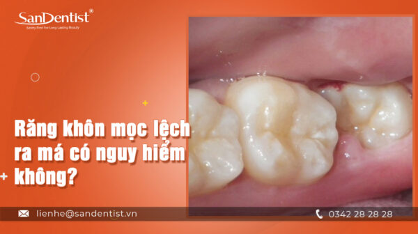 Răng khôn mọc lệch ra má có nguy hiểm không? [TÌM HIỂU NGAY]